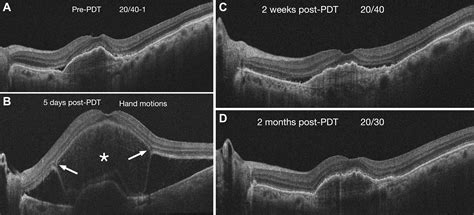 Bacillary Layer Detachment After Photodynamic Therapy Ophthalmology