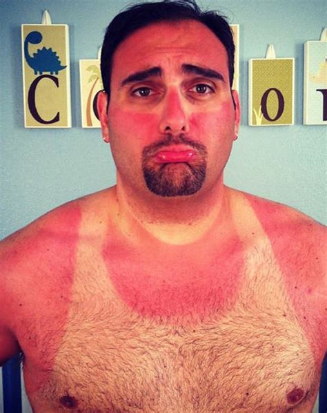 Weird And Funny Sunburns Fun