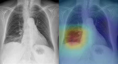 Deep Learning To Identify COVID 19 In Chest X Rays Johns Hopkins