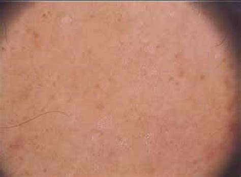 SciELO Brasil Dermatoscopic Findings Of Pigmented Purpuric