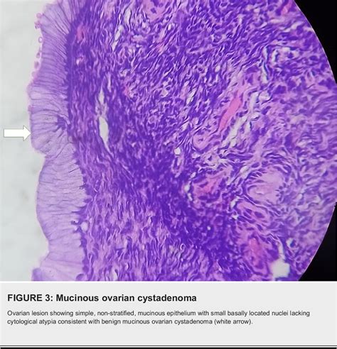 Figure 3 From A Case Report Of Pseudomyxoma Peritonei Arising From