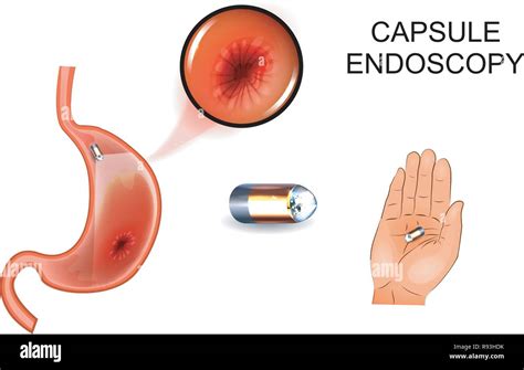 Ilustración vectorial de la cápsula endoscópica EGD gastroenterología