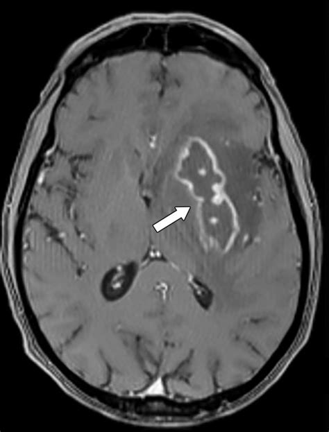 Imaging In Differentiating Cerebral Toxoplasmosis And Primary CNS