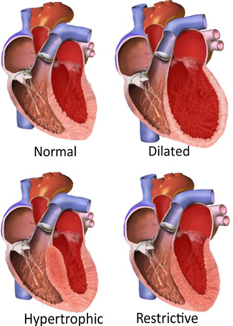 What Is Hypertrophic Cardiomyopathy In Cats Types Of Heart Disease