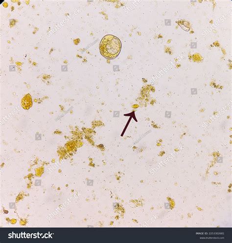 Microscopic Examination Stool Showing Trichuris Trichiura Stock Photo