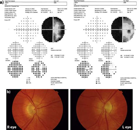 A Humphrey Visual Field Assessment Showing A Left Homonymous