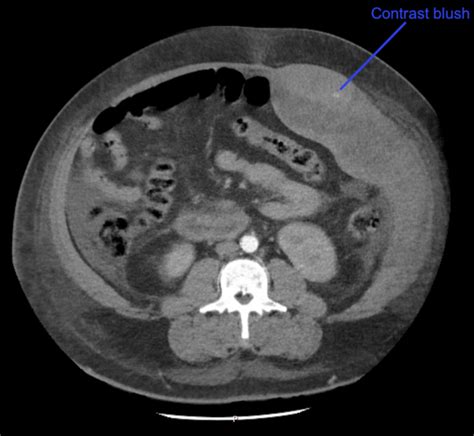 Ct Case 003 • Litfl • Ct Scan Interpretation