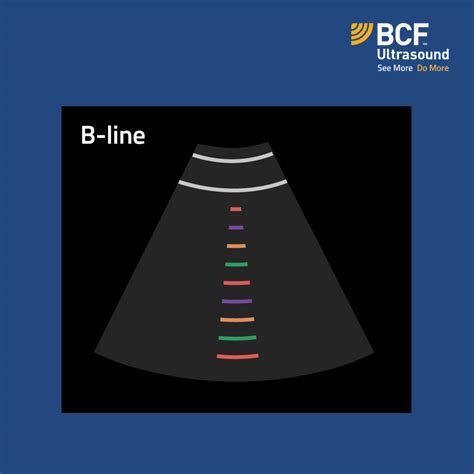 B-lines | The ABCs of Lung Ultrasound | Veterinary Ultrasonography