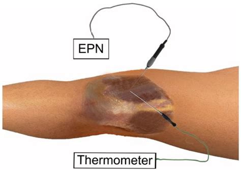 Application Of Percutaneous Needle Electrolysis Does Not Elicit