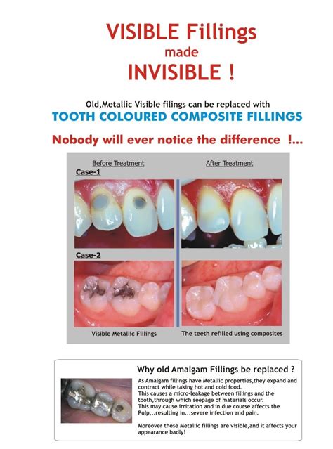 Teeth Fillings Dental Cavity Treatment Long Term Fillings