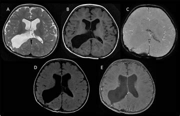 Atypical Choroid Plexus Papilloma An Uncommon Entity A Case Report