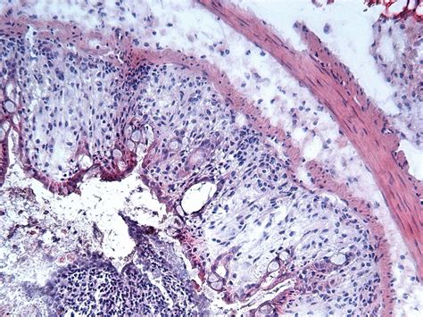 Tdb Dextran Sulfate Sodium Dss Colitis