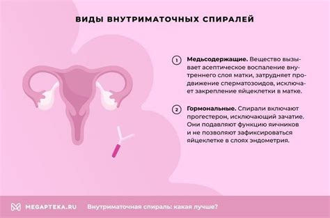 Как работает внутриматочная спираль: плюсы и минусы, виды спиралей ...