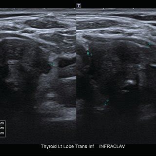 A Irregular Clusters Of Medullary Thyroid Carcinoma Cells With Clear