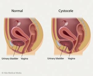 Prolapsed Bladder | Cystocele Repair Surgery | Plano, Frisco, Dallas TX