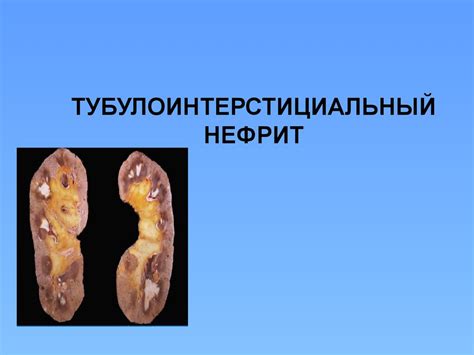 Тубулоинтерстициальный нефрит - online presentation