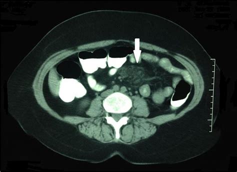 Limited Systemic Sclerosis Initially Presenting With Mesenteric Panniculitis Bmj Case Reports