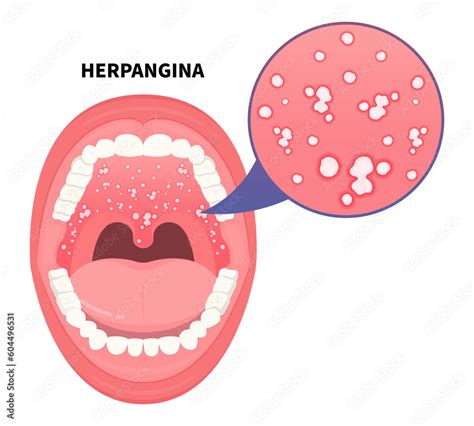 Herpangina hand foot mouth throat disease herpes strep stomatitis ...