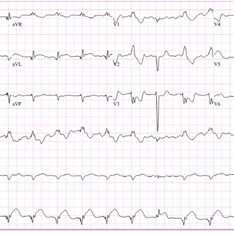 Electrocardiogram Showing Acute St Segment Elevation Myocardial