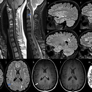 Serial T Mri Scans In Case Obtained Days After Symptom Onset