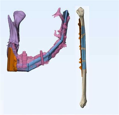 Planificaci N D Reconstrucci N Mandibular Con Colgajo Libre De