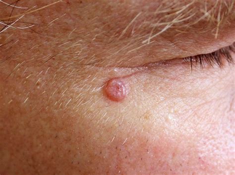 Basalioma Carcinoma Basocellulare Immagini Sintomi Pericoli E Cura Valori Normali