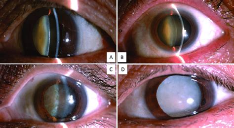 Cataract International Eye Centre