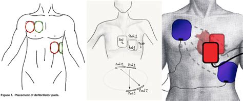 Defibrillation — The Pulse — Staten Island University Hospital