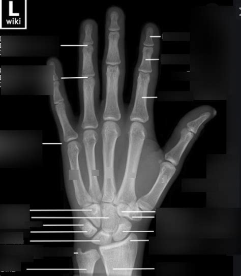 Ortho Hand Radiograph Diagram Quizlet