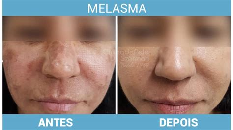 Melasma Antes E Depois Veja O Resultado Do Tratamento Laser CO2