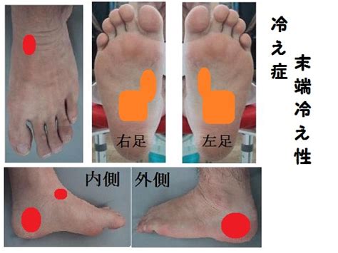 冷え性の改善に役立つ反射区（足つぼ）