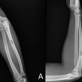 Anteroposterior A And Lateral B Forearm Plain Radiographs At