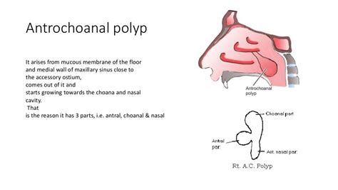 Nasal Polypi Otorhinolaryngology Types Etiology Management Ent Ppt