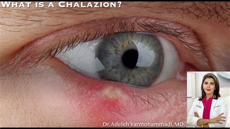 Sty Vs Chalazion