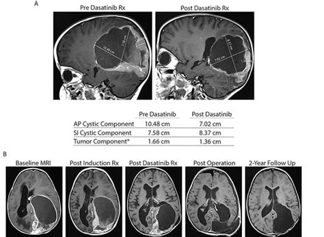 Brain Mri Demonstrating Etmr Response To Dasatinib Treatment A