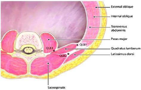 Graphic Illustration Of The Anatomy Of Three Variations Of Quadratus