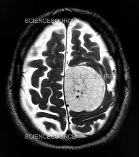 Photograph Parafalcine Meningioma Mri Science Source Images