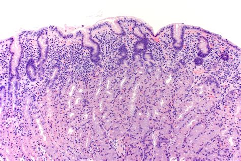 Gastric Ulcer Histology