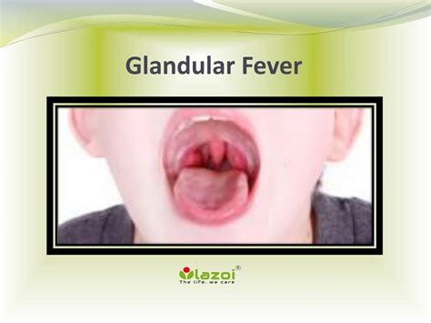 PPT - Glandular Fever PowerPoint Presentation, free download - ID:7953698