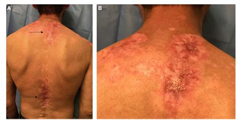 Figure 1 From Current Insights In Cutaneous Lupus Erythematosus