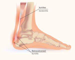 Retrocalcaneal Bursitis Signs Symptoms And Treatments Alleviate Pain