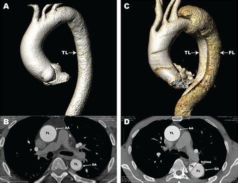 Aortic Dissection CT Scan