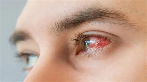 Eye Flu In India As Conjunctivitis Cases Continue To Rise Here S What Doctors Say