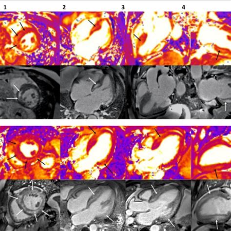 Cardiovascular Magnetic Resonance Imaging In A Patient With Cardiac Download Scientific Diagram