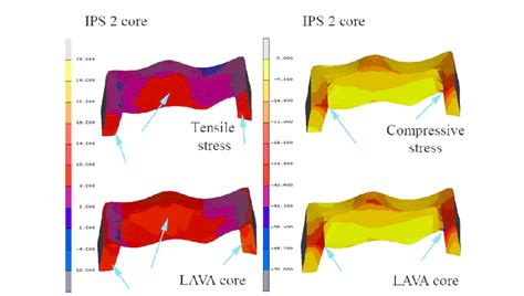 Compressive And Tensile Stresses Which Occurred In Inlay Cores Blue Download Scientific