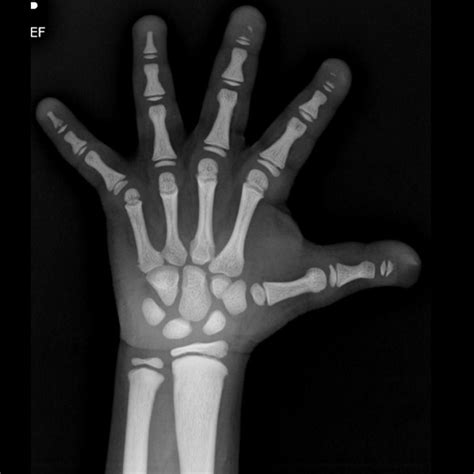 an x - ray image of a hand with bones on it's palm and fingers