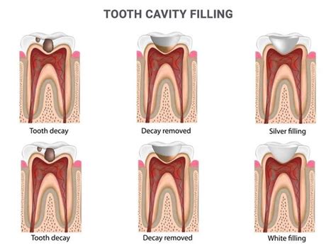 Cavity Filling Downtown NYC | Cavity Treatment Manhattan