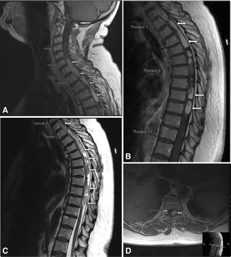 Magnetic Resonance Imaging Of Cervical Thoracic Intradural