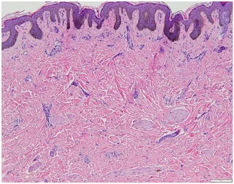 Punch Biopsy Hande Showing Epidermal Acanthosis Regular Elongation Of