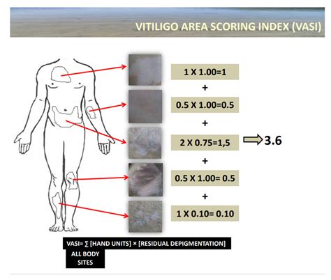 New Approaches To The Diagnosis Of Vitiligo